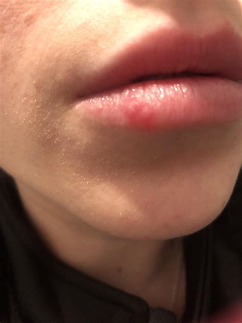 What Is A Bump On My Virginia Lip at Michelle Reis blog