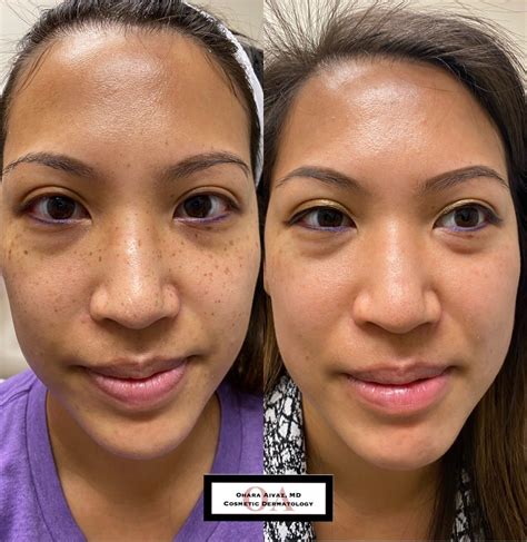 Pigmentation and Freckle Removal Before and After Photo Gallery — Dr. Ohara Aivaz, dual board ...
