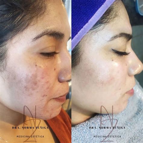 Plasma Rico en Plaquetas Antes y después - Multiestetica.mx