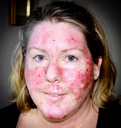 My Journey Through Topical Chemotherapy - Fluorouracil 5% Cream and Carac .5% Fluorouracil Cream ...