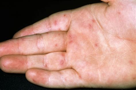 Hand, Foot, and Mouth Disease (HFMD): A Comprehensive Guide