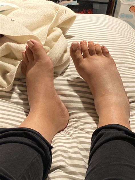 Leg Foot Swelling After C Section at Frank Thill blog