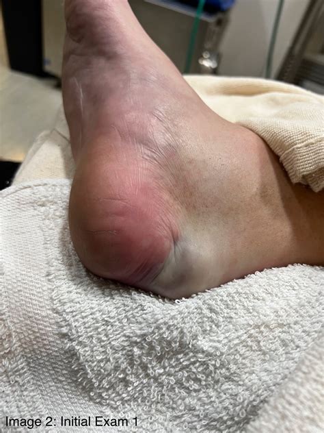 Calcaneus Fracture Swelling