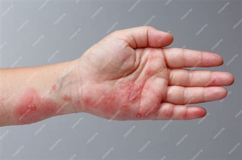 Herpes Rash Hand