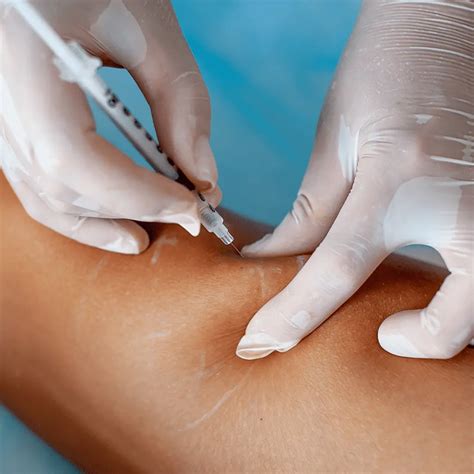 Is Sclerotherapy Right for Me? - The Vein Institute