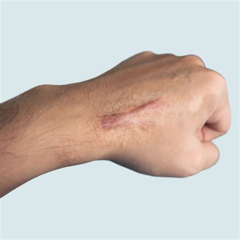 The Difference Between Keloid & Hypertrophic Scars