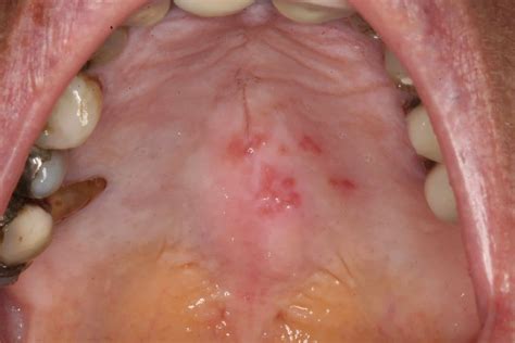 Herpes Inside Roof Of Mouth