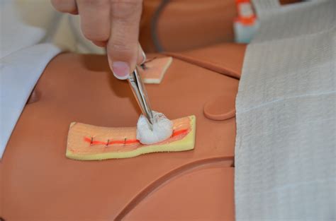 Suture Staple Removal Procedure at Jerry Magnuson blog