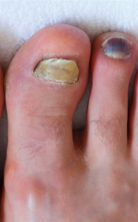 Toe Nails Falling Off