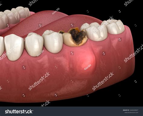 1+ Hundred Gum Inflammation Cyst Royalty-Free Images, Stock Photos & Pictures | Shutterstock