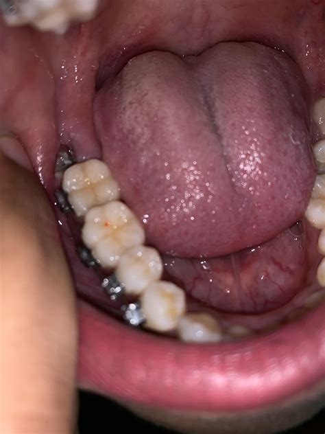 5 days post wisdom tooth extraction. Referring to the photo, is this normal. Like I can see a ...