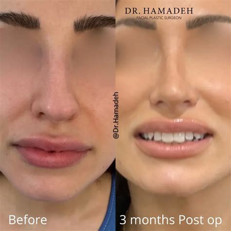 Septoplasty Before and After - Before After Journey