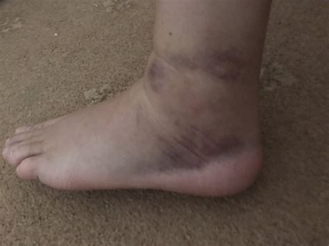 Avulsion Fracture Ankle