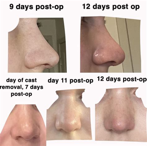 Swelling Face After Nose Surgery