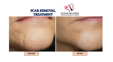 Laser Scar Treatment In Ghana at Arthur Yasmin blog