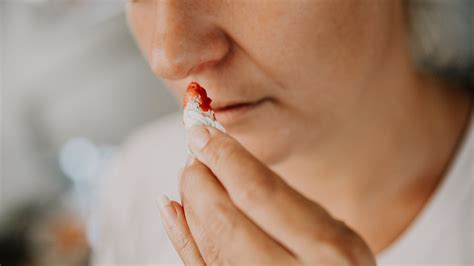 Nosebleed Causes: Everything You Should Know - GoodRx