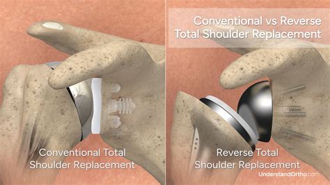 Total Shoulder Replacement – UnderstandOrtho™