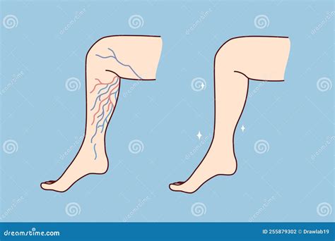 Patient Legs with Varicose Veins Stock Vector - Illustration of result, thrombosis: 255879302