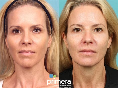 Sculptra® Before and After Pictures Case 906 | Orlando, Winter Park ...