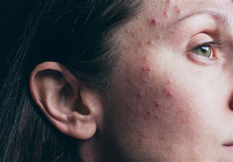 What to Know About Steroid Pimple Injections