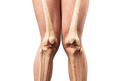 Knock Knees (Genu Valgum) in Children and Adults