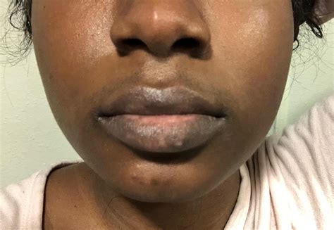 Causes Of Dry Skin Around Lips at Harry Quintana blog