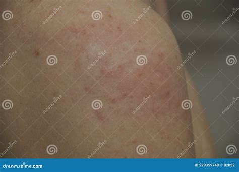 Head And Shoulders For Eczema at Brenda Sherman blog