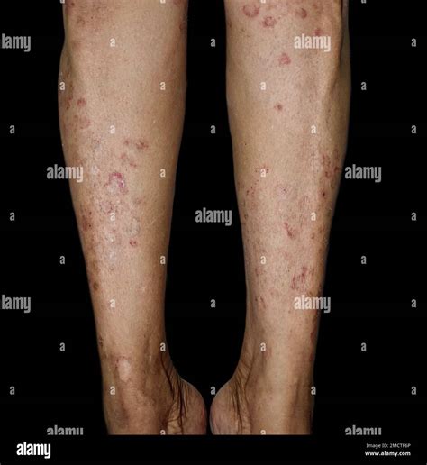 Can Tinea Versicolor Spread To Legs at Toya Mccloud blog