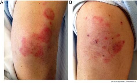 Erythema Annulare Centrifugum Thigh