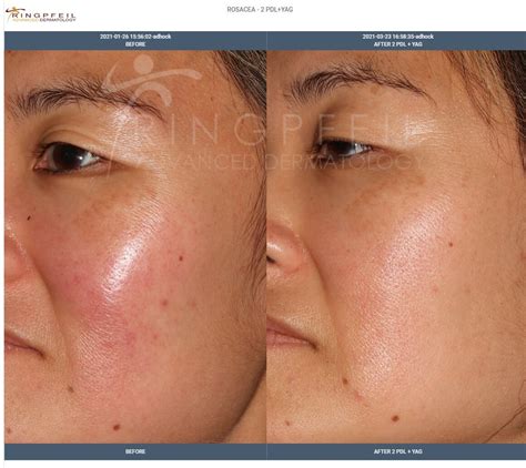 Rosacea Laser Treatment Bruising