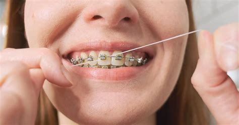 Mastering Flossing Techniques with Braces - ORLAND PARK ORTHODONTICS