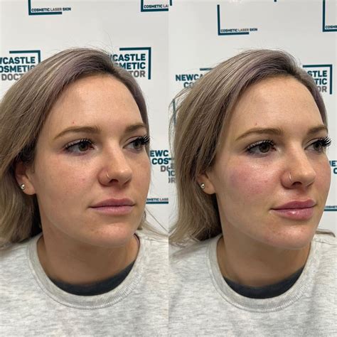 Mid face cheek filler – Artofit