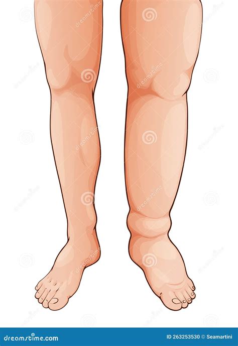 Edema Lymphedema Disease Swollen Leg and Foot Stock Vector - Illustration of medical, ankle ...