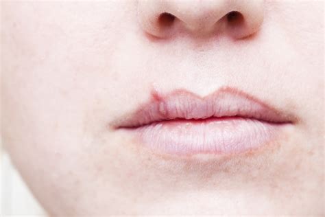 Nasal Cold Sores