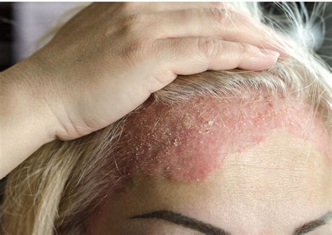 Dermatitis en la cara: causas, síntomas y soluciones - CIO Salud