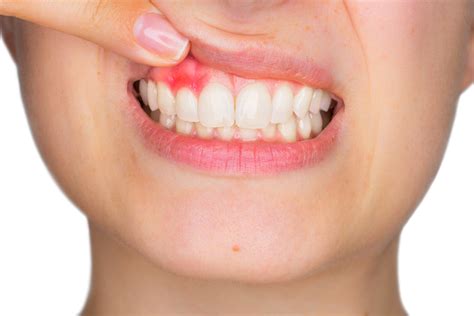 What Deficiency Causes Bleeding gums? – Garden Dental