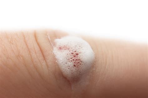 How To Use Hydrogen Peroxide For Cleaning Wounds at Virginia Barr blog
