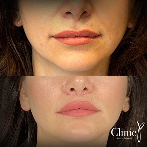 Lip Lift – Clinic P | Aesthetic Surgery Turkey