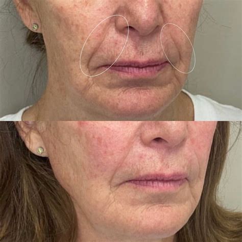 Sculptra Before & After Photos in Oak Brook, IL