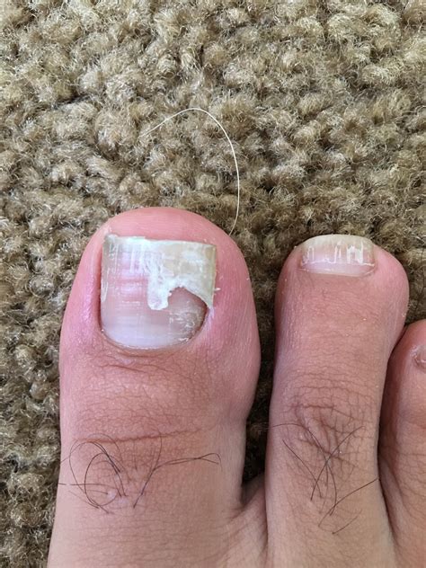 How To Treat Pain Under Big Toe Nail at Eva Brown blog