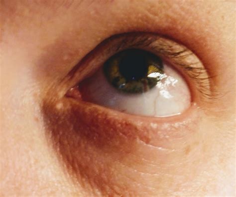 Any idea what the white spot is in the inner corner of my eye? It's been there for a while but ...