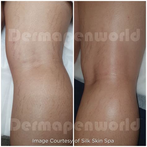 Treat Stretch Marks | Stevenage | Hitchin