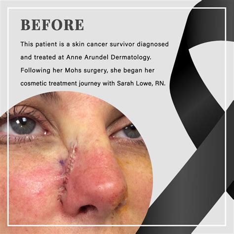 Cosmetic Surgery Scar Treatment