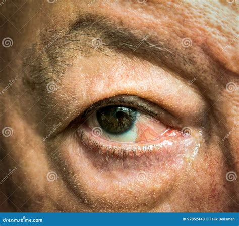 Surgical Removal Of Pyogenic Granuloma On Skin Royalty-Free Stock Photography | CartoonDealer ...