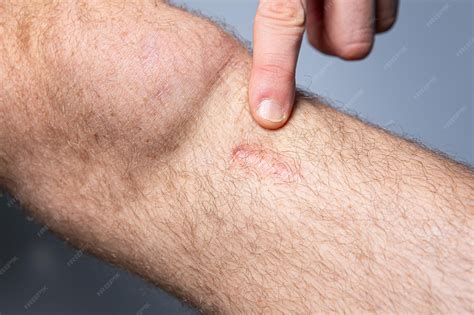 Premium Photo | Mans Arm with Swollen Red Skin from Allergic Reaction