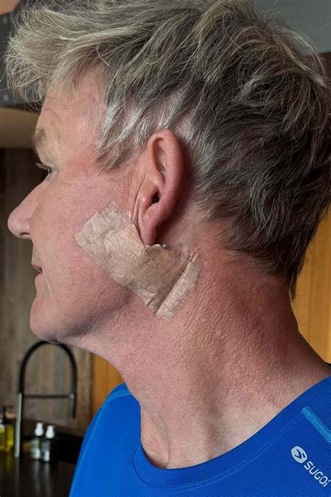Gordon Ramsay shows off his skin cancer scar: 'It's not a facelift'