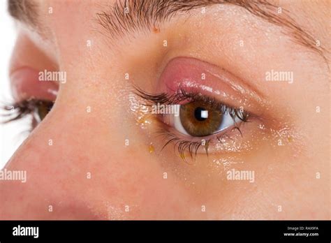 Close up picture of upper eyelid inflammation - chalazion - young ...