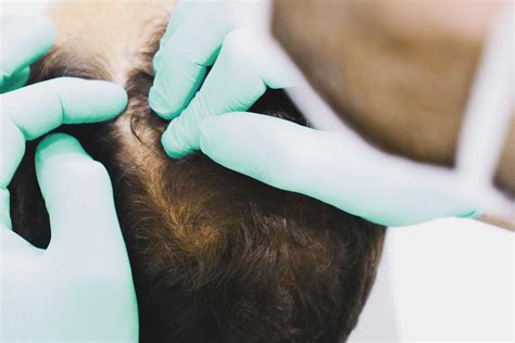 GRANOS EN LA CABEZA: ¿Por qué aparecen y cómo tratarlos?