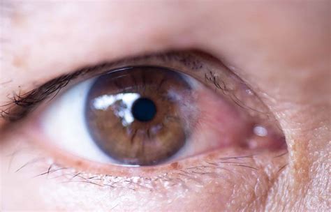 Ocular Surface Disease - Cornea & Cataract Consultants of Arizona