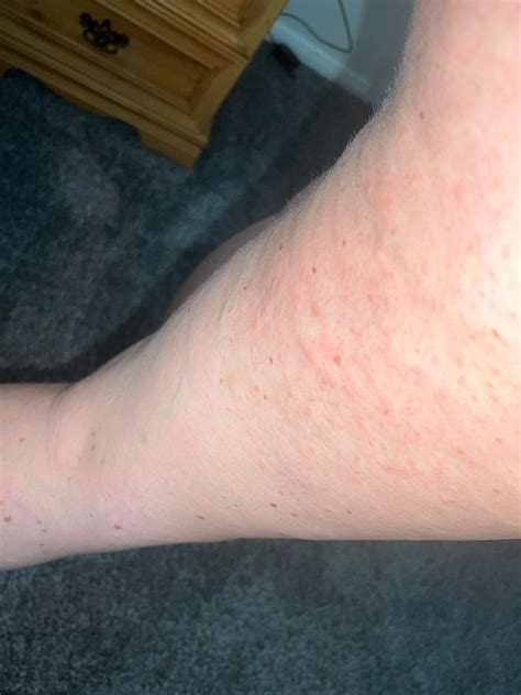 Very Itchy Legs / Red Bumps : r/DermatologyQuestions